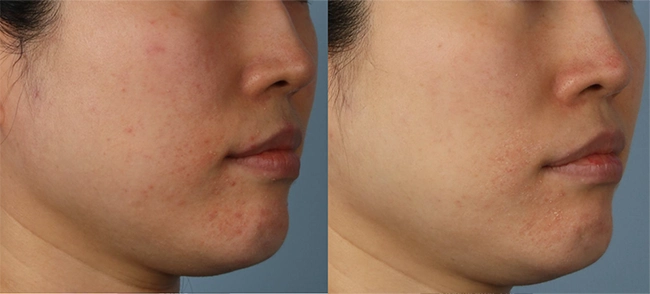 XERF Before & After 1