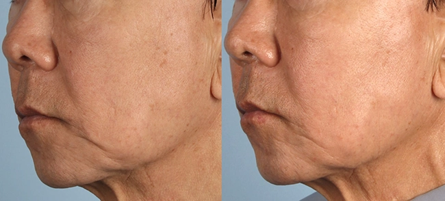 XERF Before & After 2