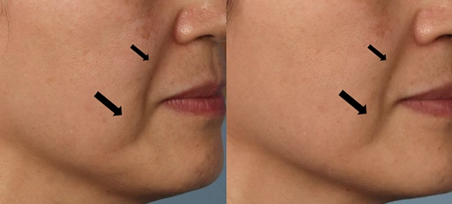XERF Before & After 5