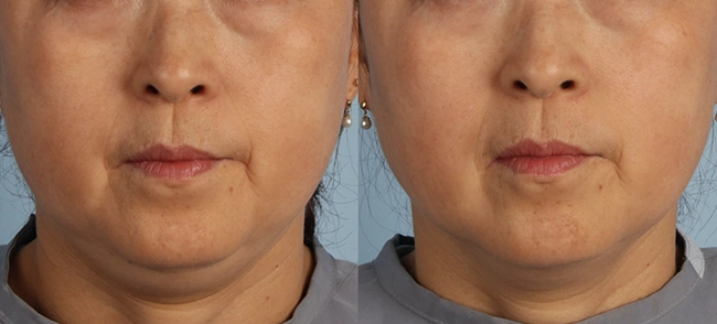 XERF Before & After 6
