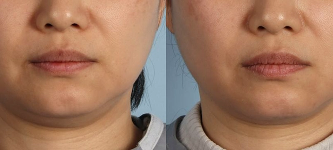 XERF Before & After 7