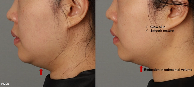 XERF Before & After 8