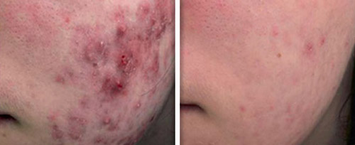 acne_treatment_kaliterna