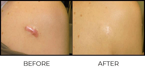 Keloid Treatment before after (2)