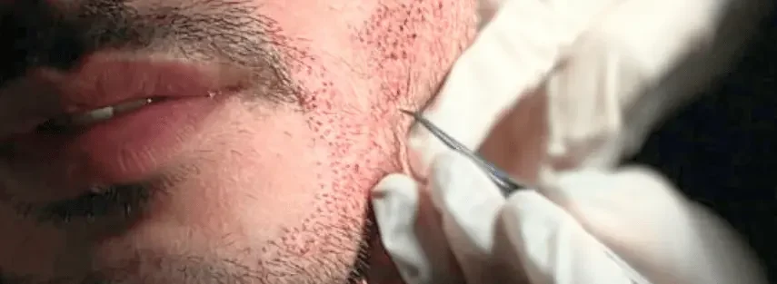 Beard Transplant