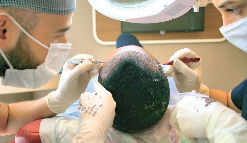 Hair transplantation