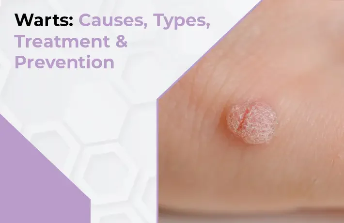 Warts Causes, Types, Treatment & Prevention