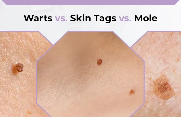 Dermatology-based treatments for skin tags, moles, and warts